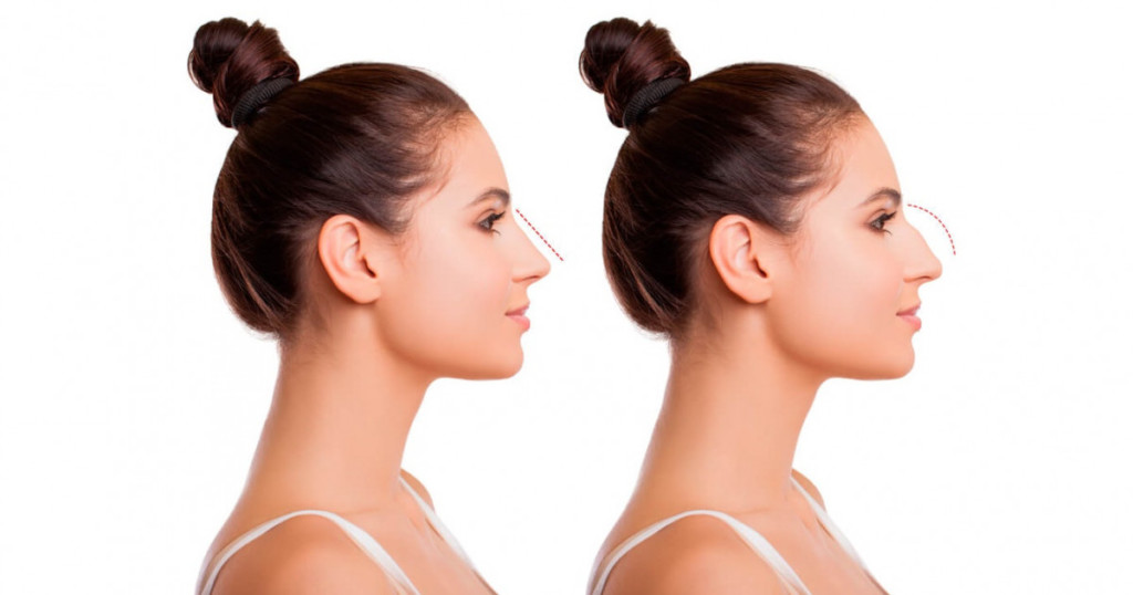 Rhinoplasty: why perform this operation, risks and postoperative