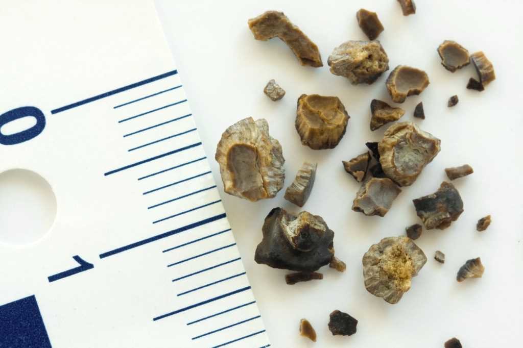 kidney stones 1