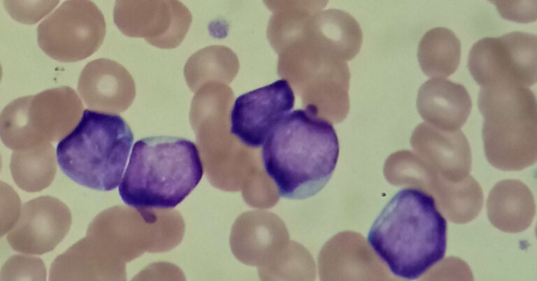 Lymphoblasts: Their Definition, Properties, and Role in the Human Body